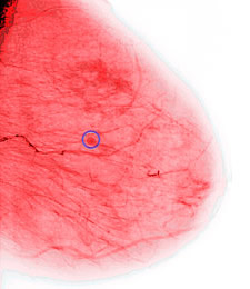 A new study is the first to produce evidence that exercise improves the prospects of beating a malignancy, and proves that being physically active boosts the odds that breast cancer patients will survive the disease.