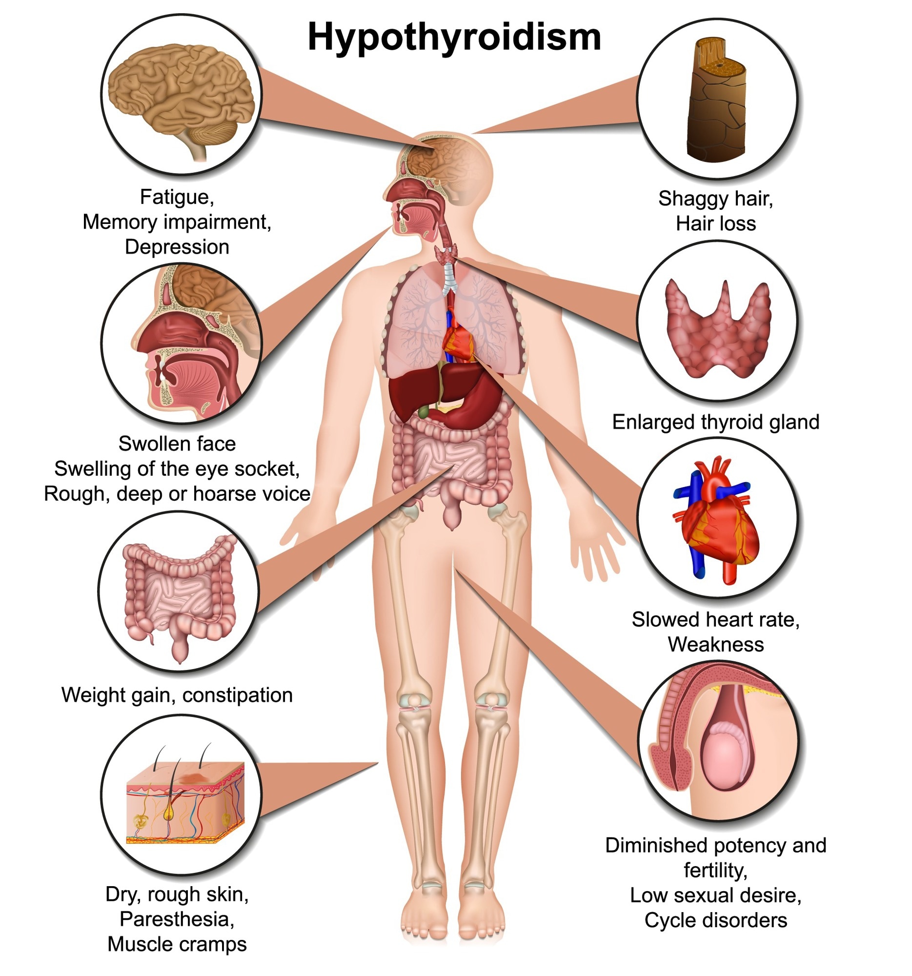 Hyperthyroidism or over active thyroid. Hyperthyreosis. Signs and Symptoms thyroid dysfunction - Image Copyright: medicalstocks / Shutterstock