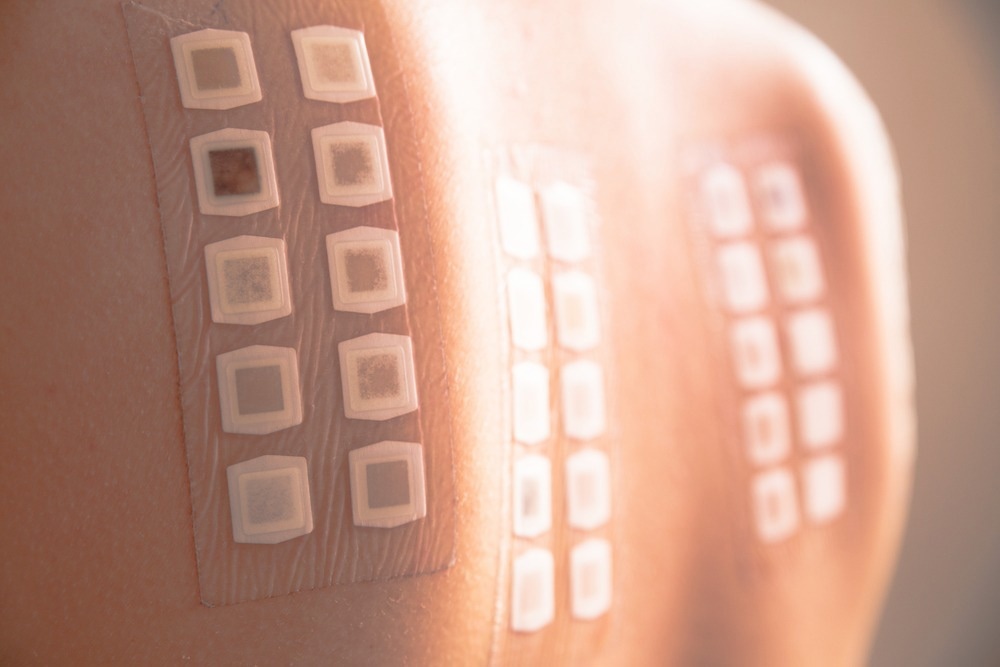 lose-up view of an allergy patch test applied to a person