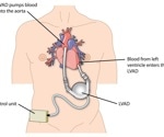 Exploring Ventricular Assist Devices