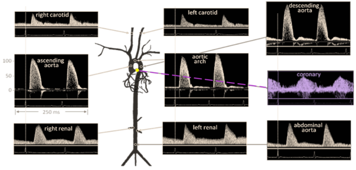 Doppler Signal from Mouse Aorta and Arteries. Velocities are similar in magnitude and shape to those from humans. Coronary blood flow velocity is highlighted in purple coloring