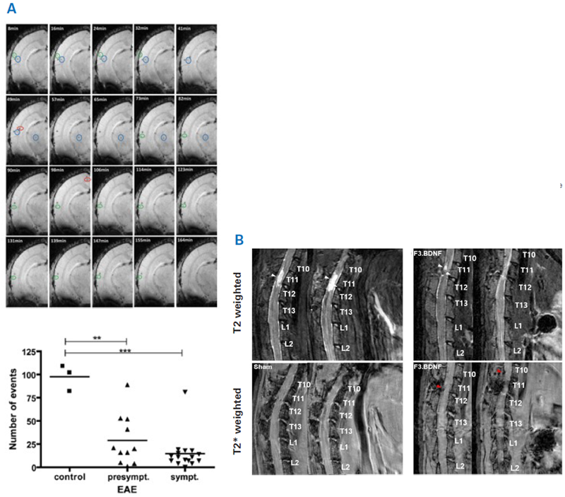 Examples for using MRI for examining cell therapy. A) Top: Time-lapse MRI for tracking inflammatory cells. Shown are 20 time frames (8, 16,…until 164 min) of one coronal T2*-weighted image from a brain of naïve mouse after intravenous injection of iron oxide nanoparticles. Hypointense spots represent labelled immune cells. Bottom: Cell trafficking was assessed in EAE and control mice after injection of iron oxide nanoparticle labelled monocytes. The number of counted hypointense spots (overall events) were significantly higher in naïve as compared to EAE mice, both at the pre-symptomatic and symptomatic stage. **p < 0.01 and ***p < 0.001. B) Detection of Feridex®-labeled human neural stem cells overexpressing brain-derived neurotrophic factor (F3.BDNF) in a rat contusion model of spinal cord injury. T2-weighted and T2*-weighted MRI images at 72 days after contusive spinal cord injury and infusion of either F3.BDNF cells or medium as control. The white arrowheads indicate the lesion, while the red arrowheads indicate labeled F3.BDNF cells. There is a marked reduction in the hyperintense lesion between the F3.BDNF group and control