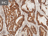 CAR-NK Cell Therapy: Therapeutic and recombinant targets