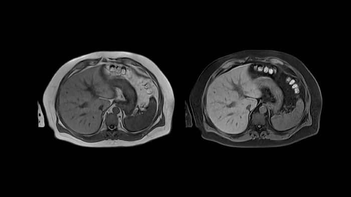 80 cm bore MAGNETOM Free.Max