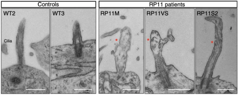 Transmission electron microscopy images showing shorter cilia in patient-derived photoreceptors, with abnormal bulbous morphology (red star). Scale bar (500 nm).