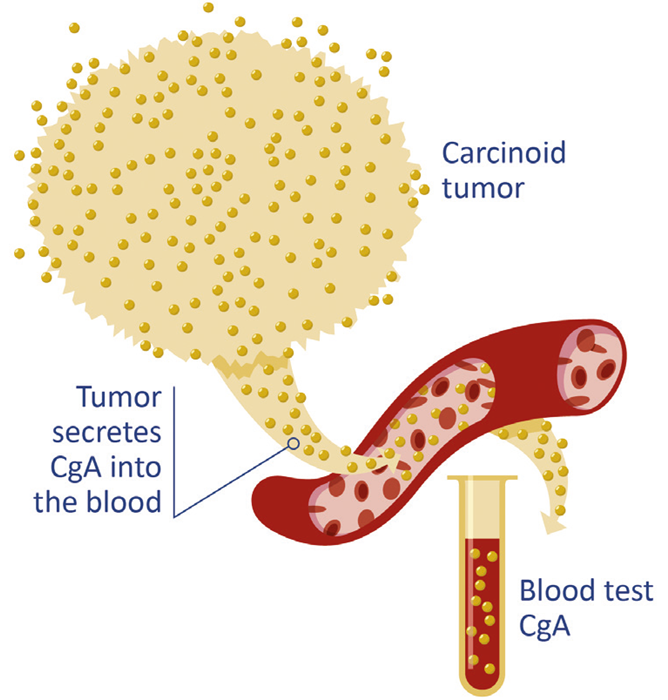 Chromagranin A ELISA: The best marker for diagnosis of neuroendocrine tumors