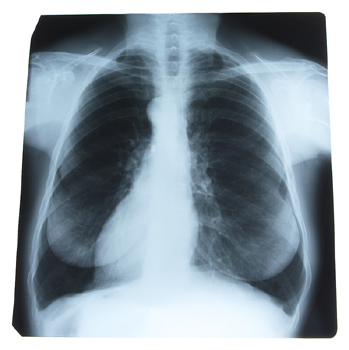 Results of the most comprehensive analysis to date of the impact of gender differences in lung cancer incidence in the United States indicate that lung cancer rates among men are on the decline, while the rate in women remains steady.