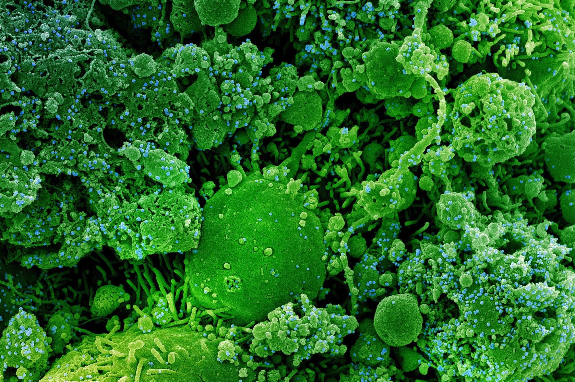 Study: Time-Varying Mortality Risk Suggests Increased Impact of Thrombosis in Hospitalized Covid-19 Patients Image Credit: NIAID