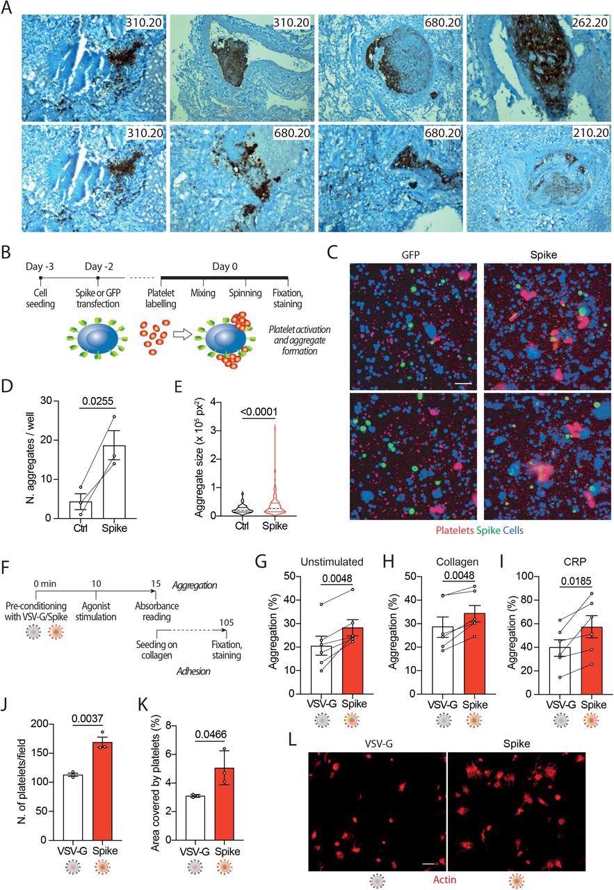 Spike enhances platelet activation. A. Histopathological evidence of platelet aggregates in the thrombotic microvasculature of SARS-COV-2-infected lungs from 4 COVID-19 patients. Numeric codes identify patients. Platelets were stained by using an anti p62 glycoprotein antibody. Magnification: x40  B. Experimental scheme to study platelet activation and aggregate formation. Vero cells transfected to express either Green Fluorescent Protein (GFP) or SARS-CoV-2 Spike were incubated with pre-labelled washed platelets and shaken at 200 rpm for 10 min at 37°C. The plate was centrifuged, fixed, and stained with Cell Mask and antibodies recognizing either GFP or Spike.  C. Representative images showing platelet aggregates. Cells stained with Cell Mask are in blue; labelled platelets are in red; GFP or Spike are in green. Scale bar, 20 μm.  D. Number of aggregates larger than 40,000 px2. Results are from