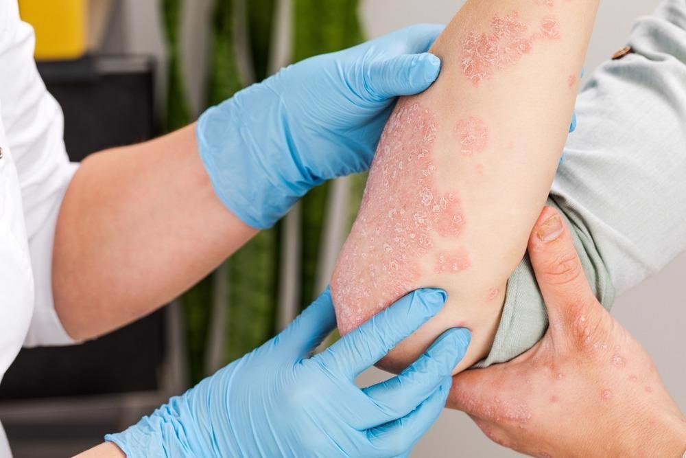 Study: Vaccine hesitancy and access to psoriasis care in the COVID-19 pandemic: findings from a global patient-reported cross-sectional survey. Image Credit: Fuss Sergey/Shutterstock.com