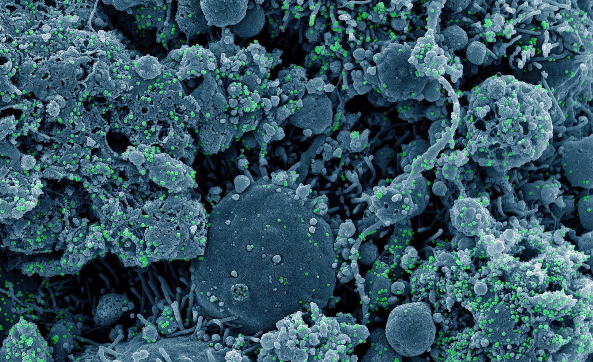 Study: Comparing the Cytokine Storms of COVID-19 and Pandemic Influenza. Image Credit: NIAID