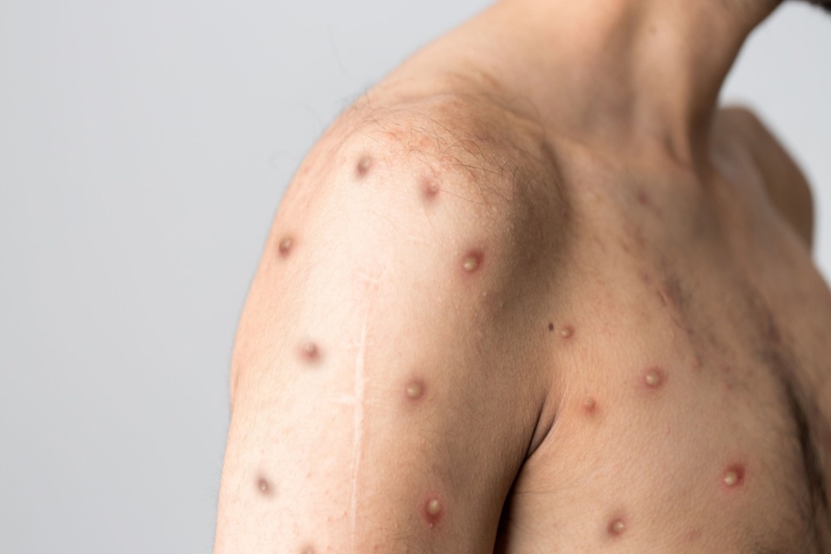 Study: Preparedness for a Monkeypox Outbreak. Image Credit: Berkay Ataseven/Shutterstock