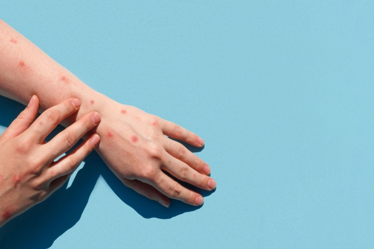 Study: Tecovirimat and the Treatment of Monkeypox — Past, Present, and Future Considerations. Image Credit: Marina Demidiuk/Shutterstock