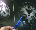 Inhaled glucocorticoids linked to changes in brain matter