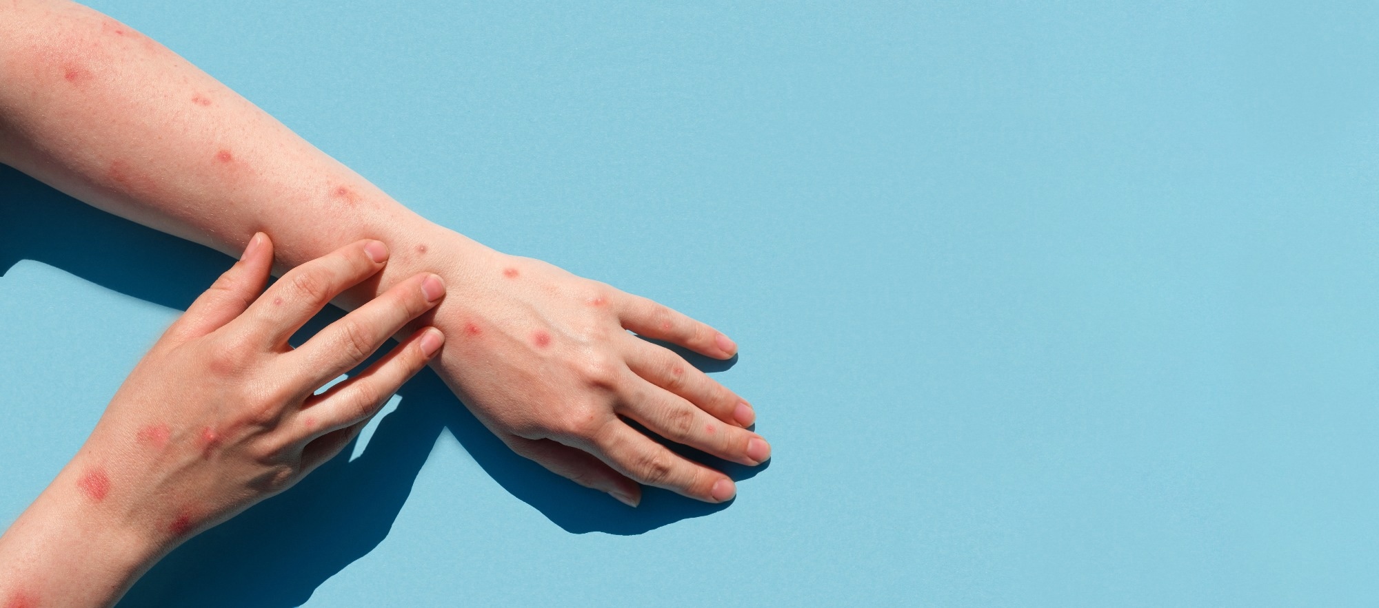 Study: The structure of monkeypox virus 2’-O-ribose methyltransferase VP39 in complex with sinefungin provides the foundation for inhibitor design. Image Credit: Marina Demidiuk/Shutterstock