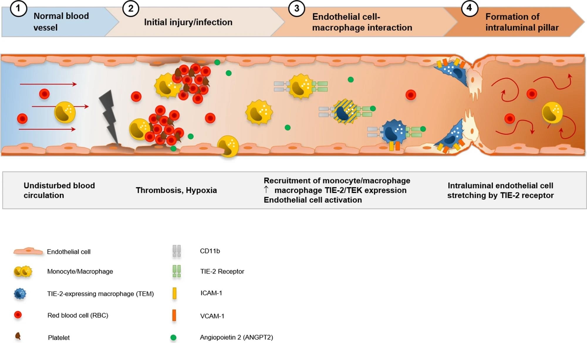 Visualization of the hypothesis of CD11b + /TIE2 + monocytes/macrophages recruitment and incorporation, and intussusceptive angiogenesis in the cardiac vasculature in COVID-19. SARS-CoV-2-related endothelial dysfunction results in thrombotic microangiopathy in cardiac capillaries and tissue hypoxia. Endothelial cells induce the recruitment of monocytes/macrophages to the site of injury by upregulation of adhesion-molecules and activation of SDF-1/CXCR4 signaling. TIE2 + monocytes/macrophages are activated by increased levels of angiopoietin 1 and adhere locally in response to angiopoietin 2 to endothelial cells. Formation of an intussusceptive pillar is achieved by intraluminal stretching of endothelial cells under the help of adherent TIE2 + monocytes/macrophages resulting in the division of a single capillary altering the cardiac microvasculature