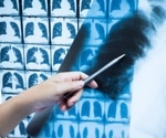 Post-COVID-19 CT scans show lung abnormalities persist two years later