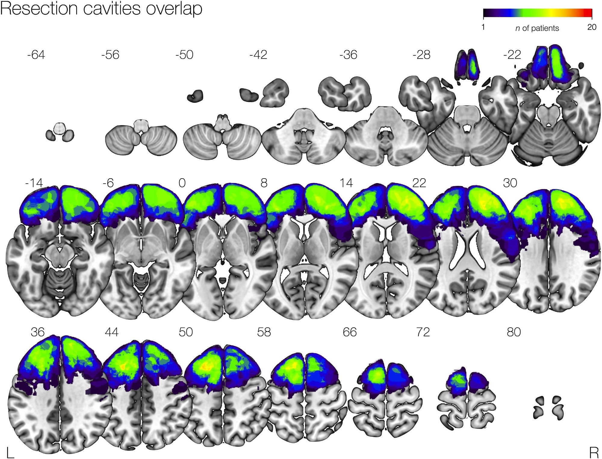 Overlap map of resection cavities in the patients’ cohort. A map of all resection cavities normalized to the MNI space is shown, with a colour bar showing voxel overlapping in a maximum of 20 patients.