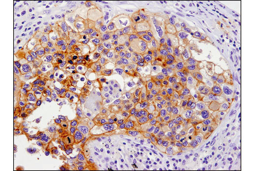Immunohistochemical analysis of paraffin-embedded human lung carcinoma using PD-L1 (E1L3N®) XP® Rabbit mAb #13684.