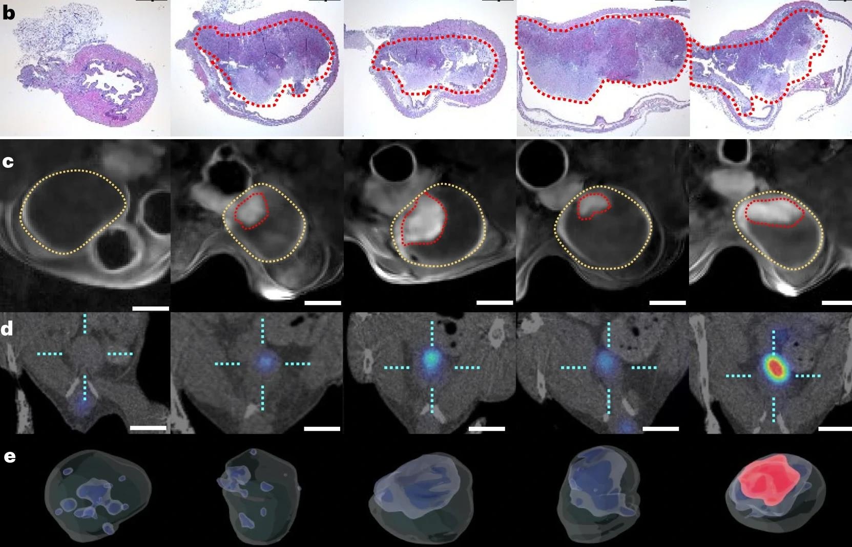 Study: Urease-powered nanobots for radionuclide bladder cancer therapy
