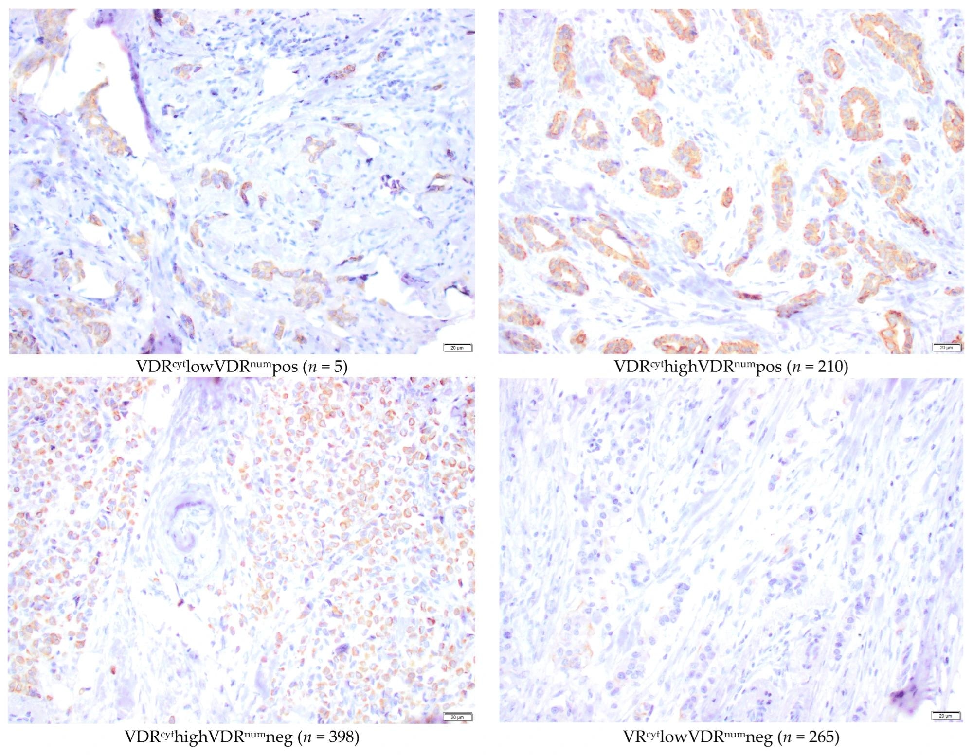 Microscopic representative images of immunohistochemical staining intensities of nuclear membrane and cytoplasmic VDR (40×) in the TMA. Bar represents 20 µm.