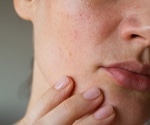 Women's skin study shows distinct chemical changes in response to psychological stress