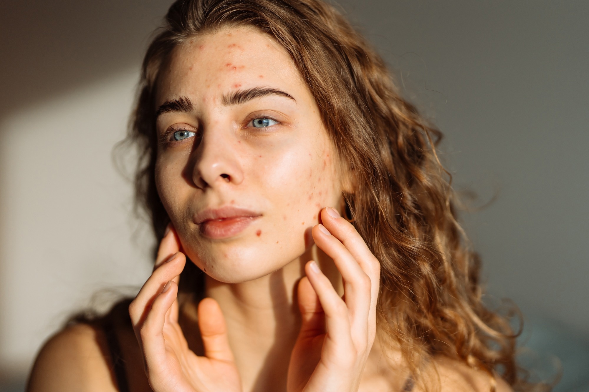 Study: Impact of Diet and Nutrition in Patients with Acne Vulgaris. Image Credi: maxbelchenko / Shutterstock.com
