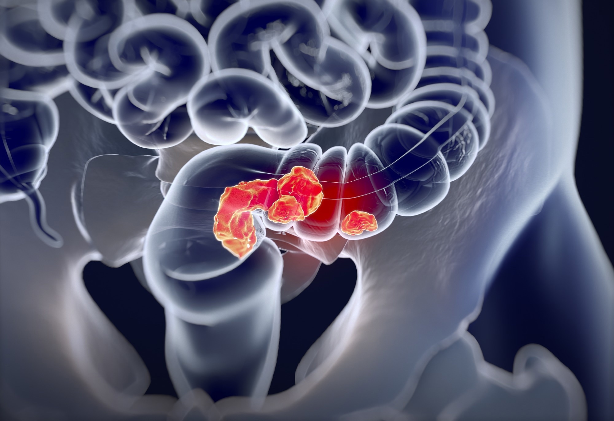 Study: Genome-wide interaction study of dietary intake of fibre, fruits, and vegetables with risk of colorectal cancer. Image Credit: Anatomy Image / Shutterstock