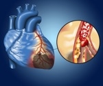 Coronary arterial inflammation linked to high cardiac event risk even without CAD