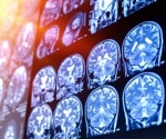 Neuroactive drugs show promising anti-glioblastoma effects in preclinical trials