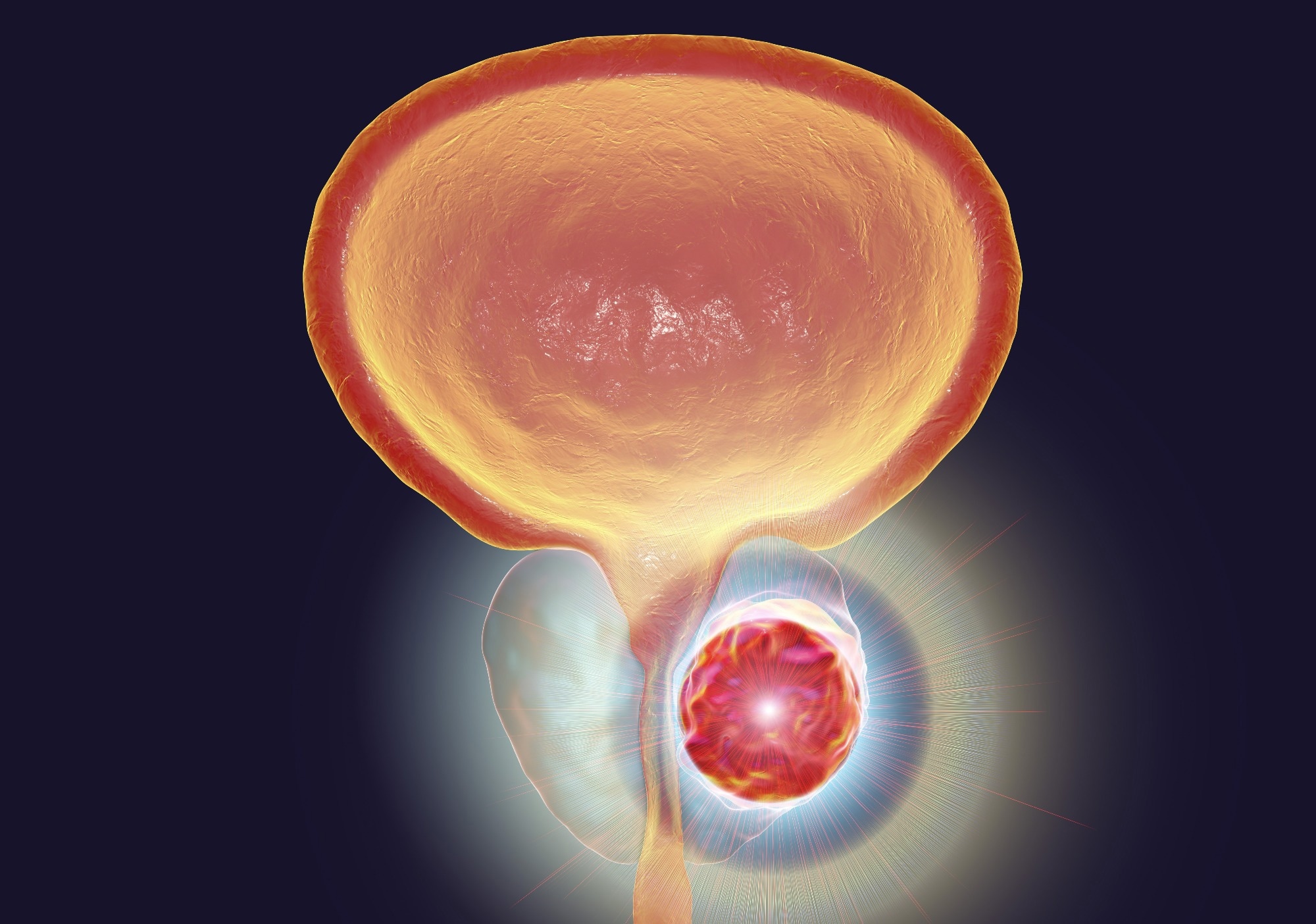 Study: Identification and analysis of microplastics in para-tumor and tumor of human prostate. Image Credit: Kateryna Kon / Shutterstock