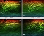 Scientists unveil a 3D photoacoustic scanner that speeds up vascular imaging for real-time clinical use