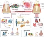 Excess sugar consumption triggers inflammation and dysbiosis, worsening periodontal disease