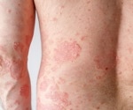 Ultra-processed foods increase active psoriasis risk, study shows