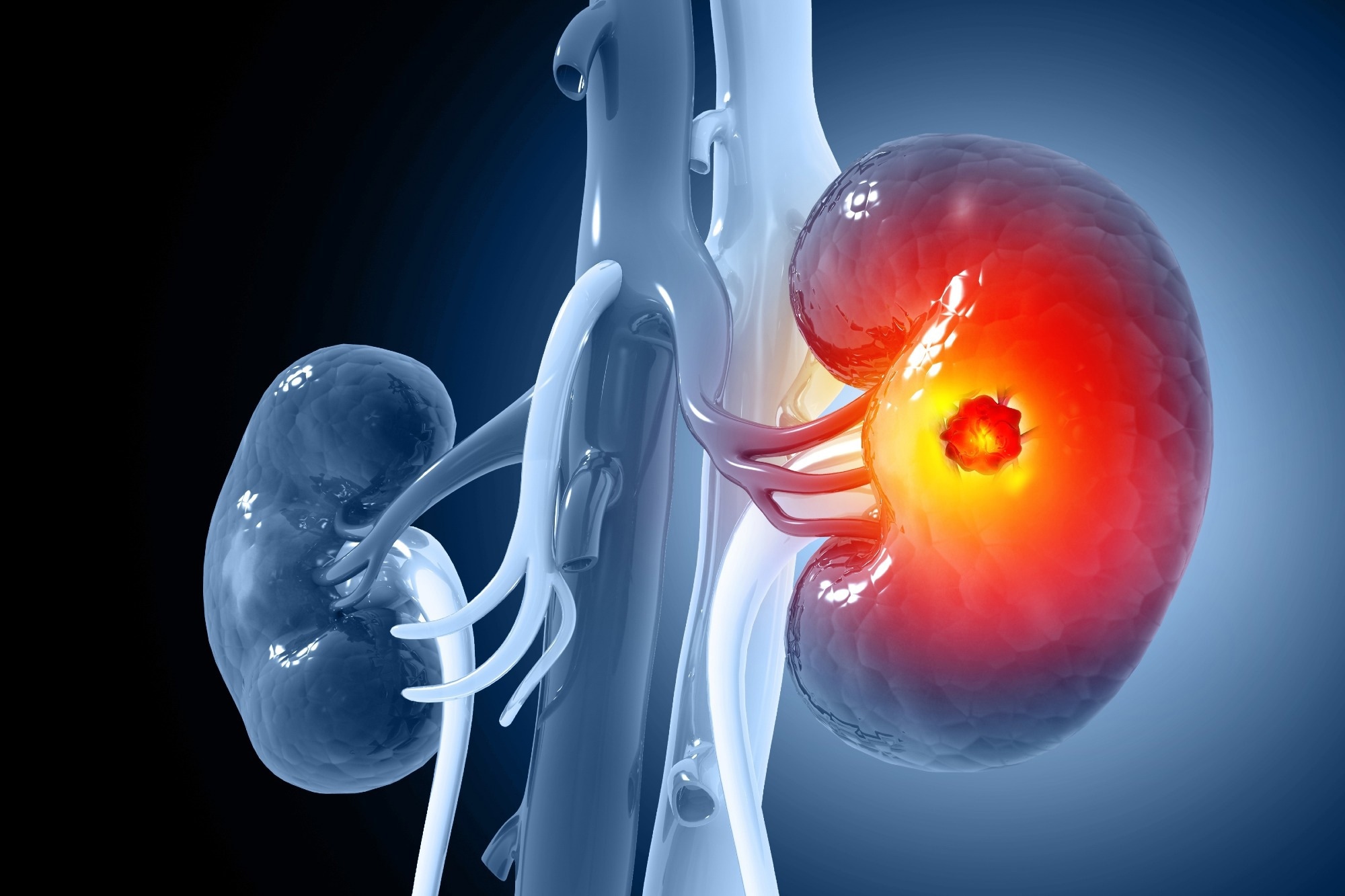 Study: A neoantigen vaccine generates antitumour immunity in renal cell carcinoma. Image Credit: crystal light / Shutterstock