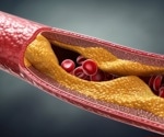 Lower LDL cholesterol linked to reduced dementia risk