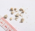 Low testosterone linked to higher kidney stone risk in men, study finds