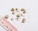 Low testosterone linked to higher kidney stone risk in men, study finds