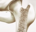 Lipid buildup predicts weaker bones once it passes a critical threshold