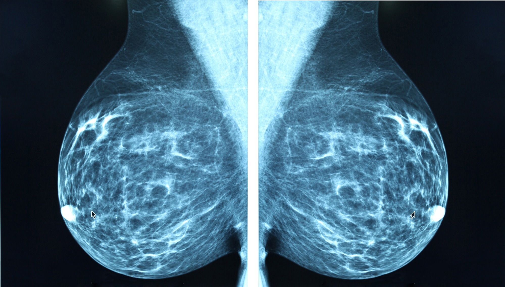 Study: Artificial Intelligence Algorithm for Subclinical Breast Cancer Detection. Image Credit: Blue Planet Earth / Shutterstock