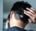 Could serotonin supplements become the next hair loss treatment?
