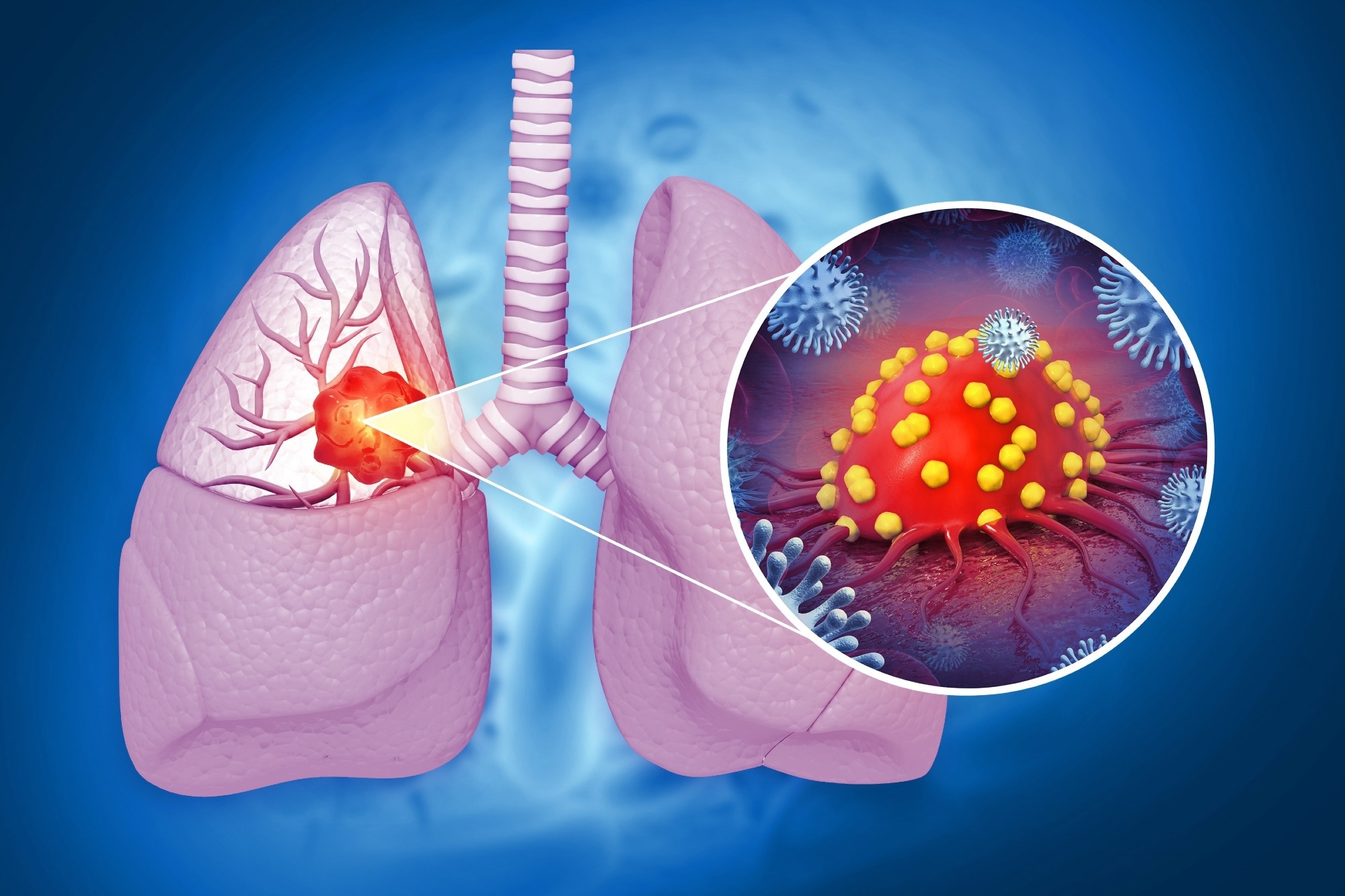 Review: Correlation between allergic diseases and lung cancer: a systematic review and meta-analysis. Image Credit: crystal light  / Shutterstock