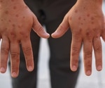Study explains why mpox cases can appear weeks after exposure