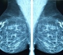 Menopausal hormone therapy shows no added breast cancer risk for BRCA carriers