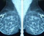 Study identifies PUF60 as a critical vulnerability in triple negative breast cancer