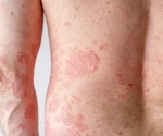 People with eczema can bathe daily or weekly without worrying about flare-ups