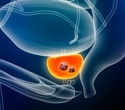 Landmark prostate cancer screening trial launches in the UK