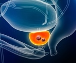 Five-session SBRT reduces side effects in intermediate-risk prostate cancer