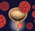 Discovery offers a breakthrough approach to combat prostate tumor growth