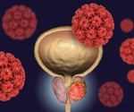Breakthrough combo therapy lowers death risk in recurrent prostate cancer